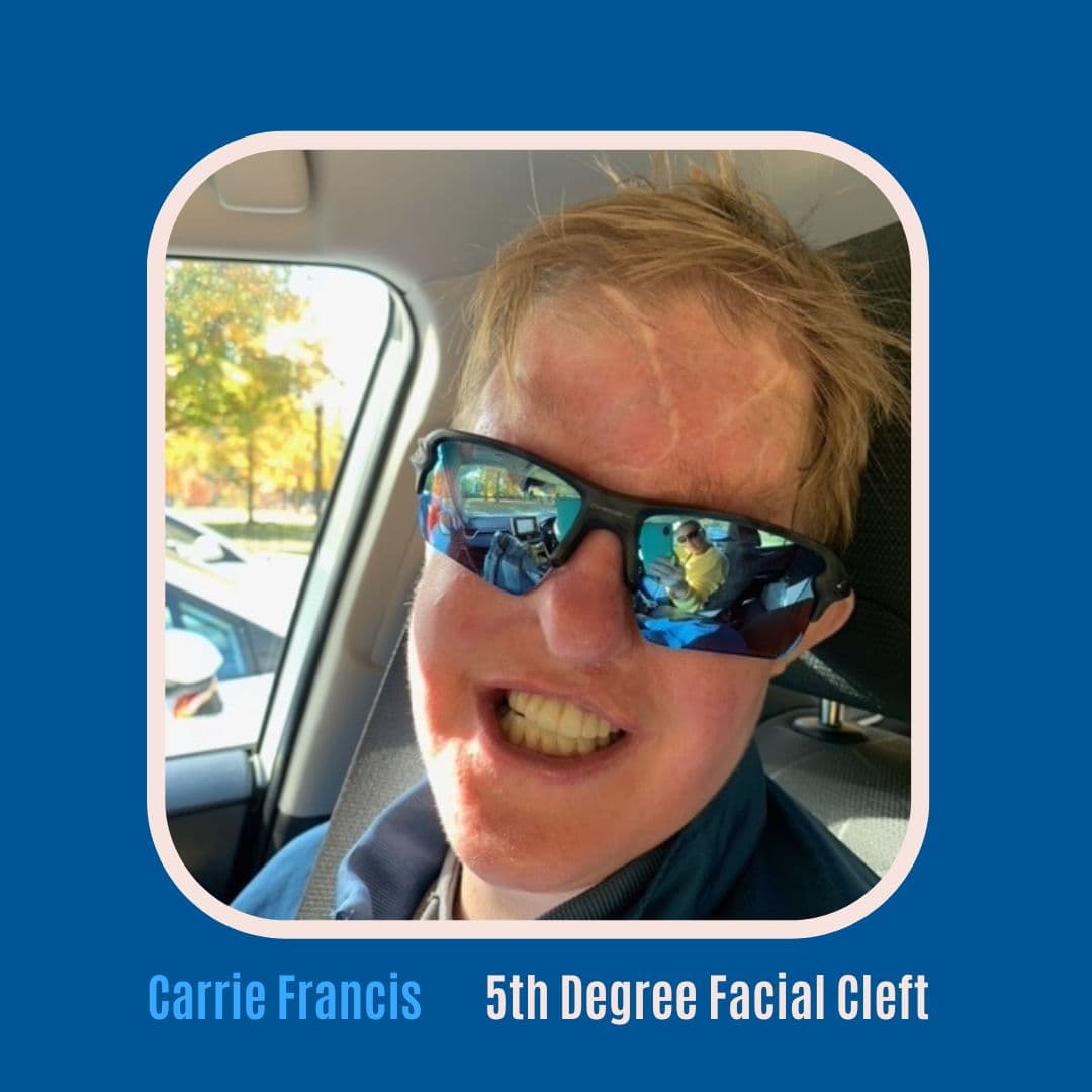#58 Living Deafblind: Carrie Francis’ Resilience After 5th Degree Facial Cleft