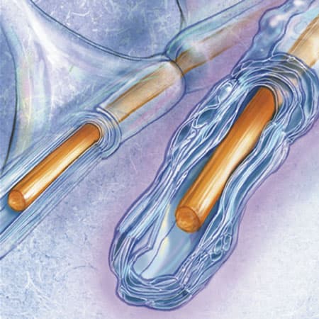 Diagnosis and Treatment of Multiple Sclerosis—A Review