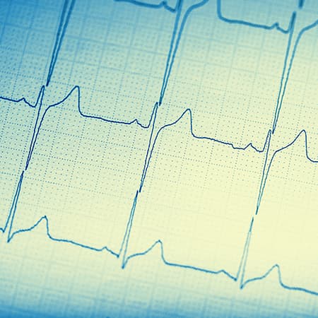 When Will It Stop? Clinicians Are Still Ordering Routine ECGs Despite Recommendations to the Contrary