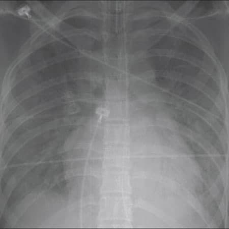 What Is New in Acute Respiratory Disease Syndrome?
