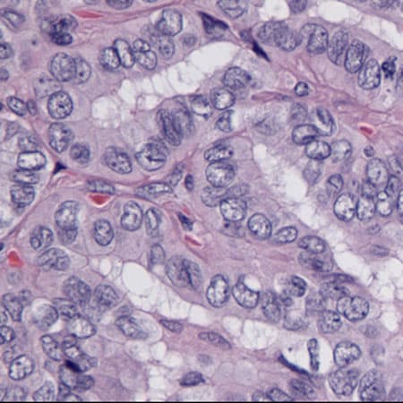 Surveillance for Thyroid Cancer
