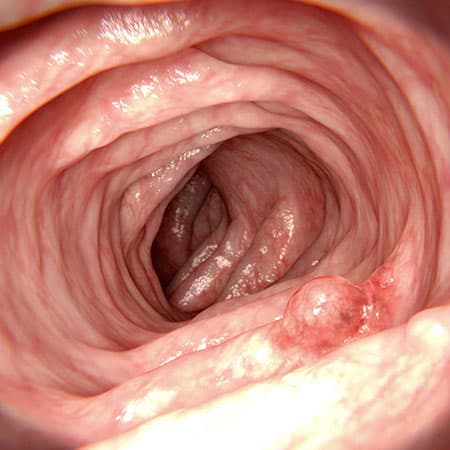 USPSTF Recommendation: Screening for Colorectal Cancer