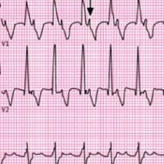 Effect of Findings From ALLHAT on Conduction System Disease