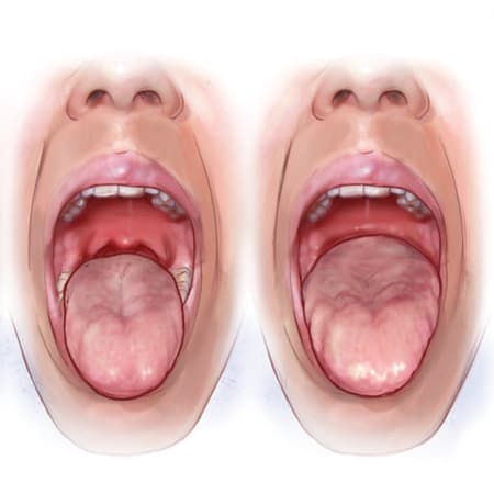 Treating Obstructive Sleep Apnea