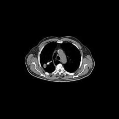 Implementation of Lung Cancer Screening in the VHA