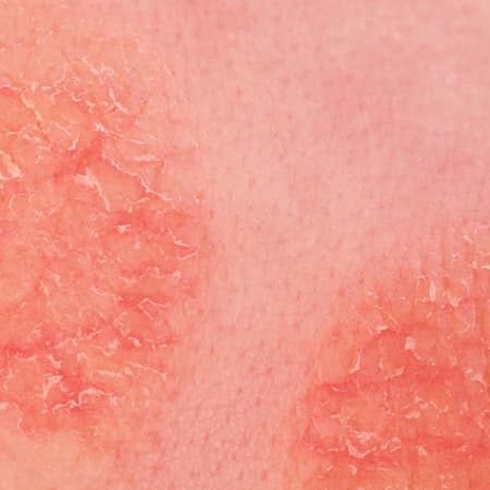 Treating Pediatric Eczema