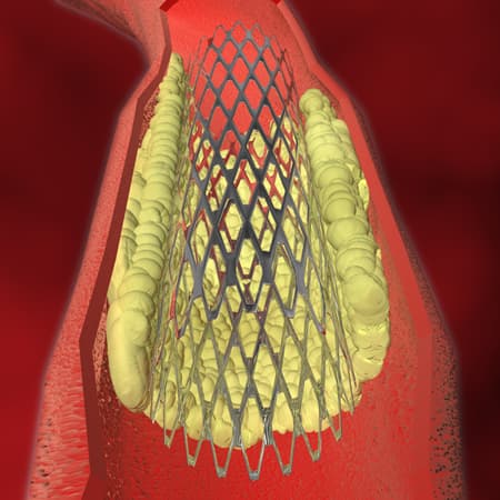 Temporal Trends in Unstable Angina Diagnosis Codes for Outpatient Percutaneous Coronary Interventions