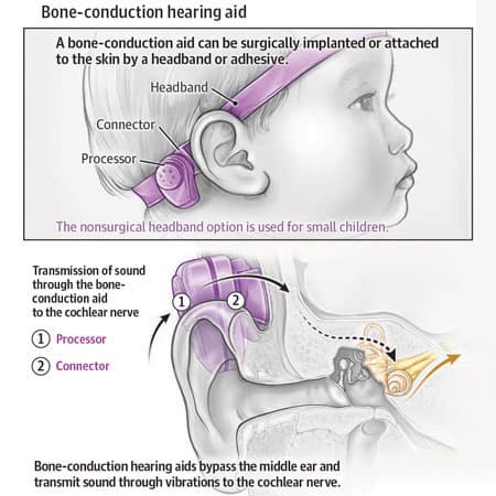Hearing Loss in Children