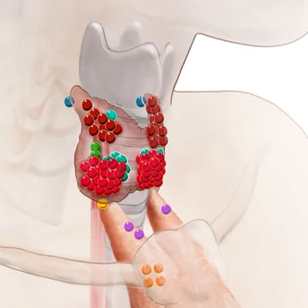 The Diagnosis and Management of Primary Hyperparathyroidism