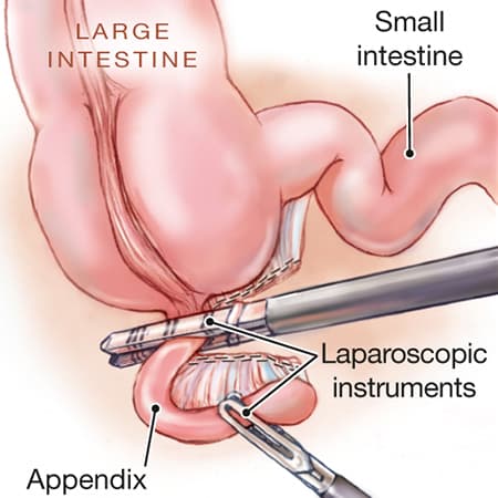 Treating Appendicitis Without Surgery – 5-Year Follow-up From a Randomized Clinical Trial of Antibiotic Treatment