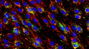 The Role of Iron in Cardiovascular Disease with Hossein Ardehali, MD, PhD