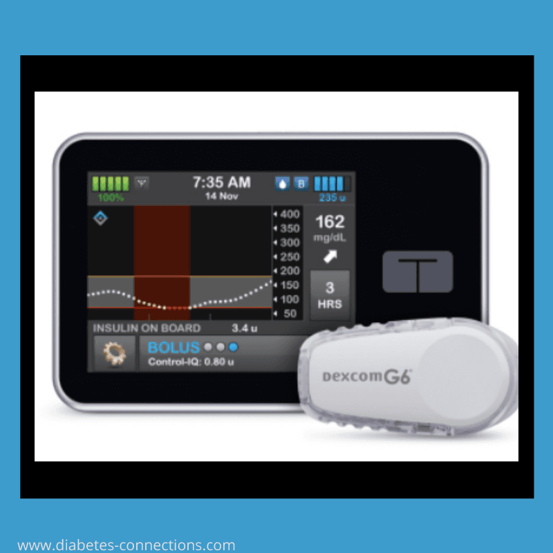 Control IQ Gets FDA Approval: All About Tandem's Hybrid Closed-Loop System