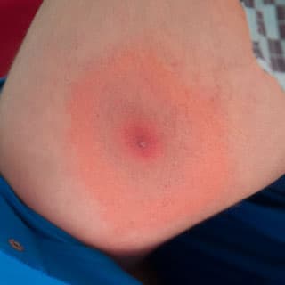 Review of Lyme Disease