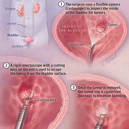 Hematuria and Bladder Cancer