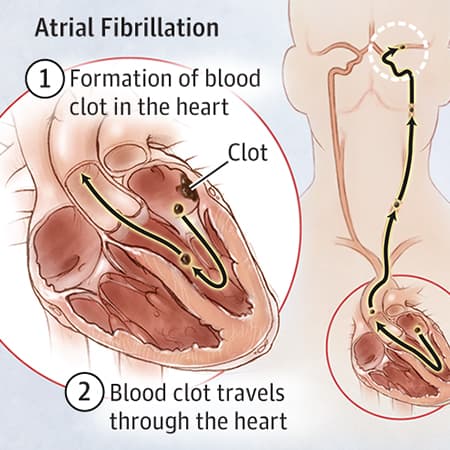 Stroke Prevention in Atrial Fibrillation