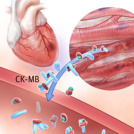 Eliminating Creatine Kinase–Myocardial Band Testing in Suspected ACS