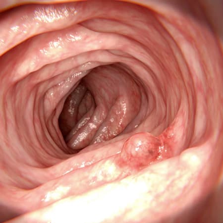 New Recommendations for How Often to Repeat Colonoscopy Following Polypectomy