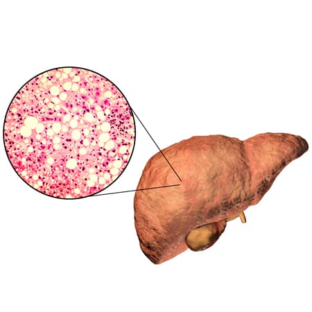 Association of Weight Loss Interventions With Changes in NAFLD Biomarkers