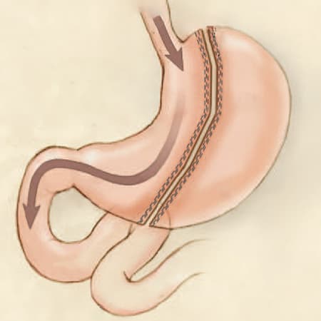 Update on Bariatric Surgery—2020