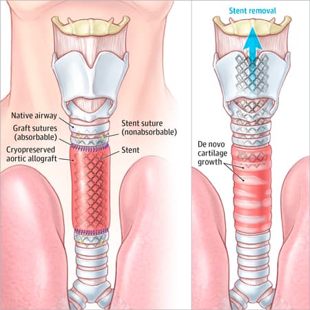 Replacing the Trachea: An Exciting New Procedure; But How Do We Know It Really Works?