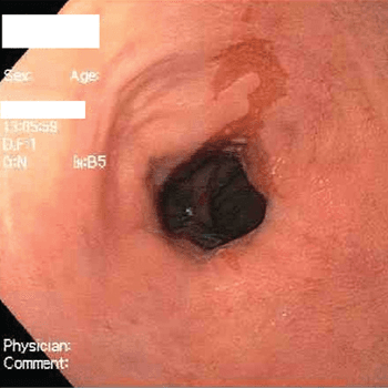GERD and Esophagitis
