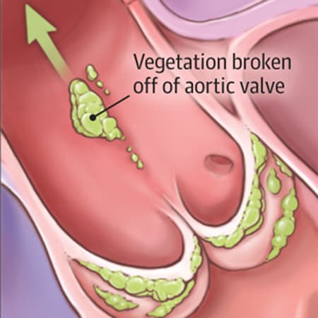 Evaluation of the Shift From Intravenous Antibiotics to Oral Step-Down Therapy for Infective Endocarditis