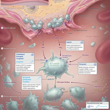 Dual Antiplatelet Therapy After Acute Coronary Syndrome