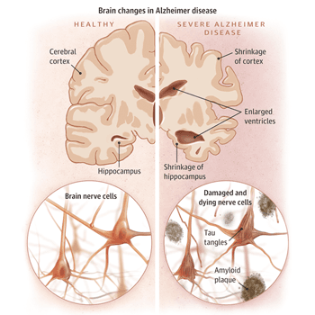 Alzheimer Outlook Far From Bleak