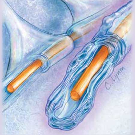 New Inroads Against Multiple Sclerosis