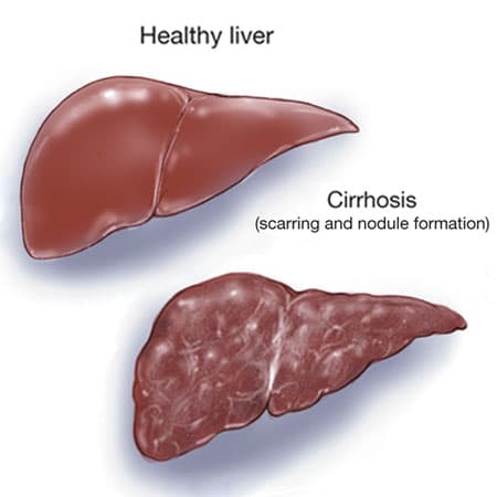 Diagnosis and Treatment of Alcohol-Associated Liver Disease