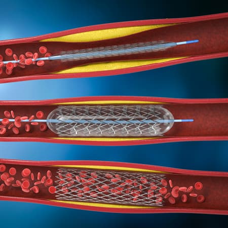 Ticagrelor or Clopidogrel for Antiplatelet Therapy After Percutaneous Intervention for Acute Coronary Syndrome?