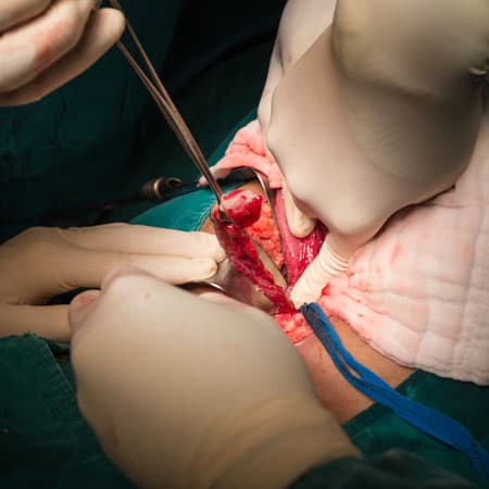 Oral Antibiotics for Appendicitis
