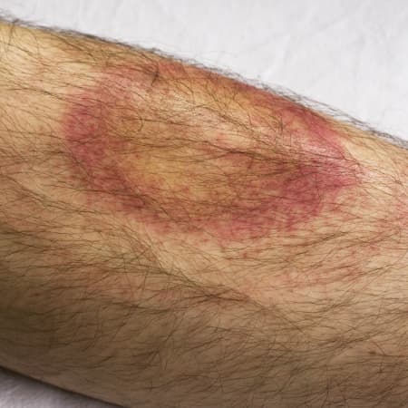 Treating Lyme Disease in 2018, Part 2