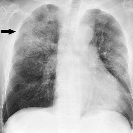 Updated Guidelines for the Treatment of Community-Acquired Pneumonia