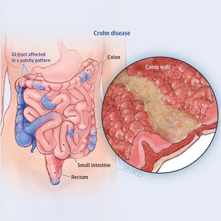 Crohn Disease Management