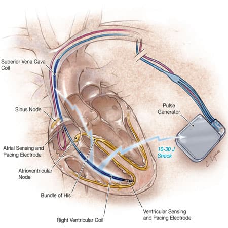 Outcomes Associated With Implantable Cardioverter Defibrillator in Adults With Chronic Kidney Disease