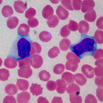 Diagnosing Infectious Mononucleosis