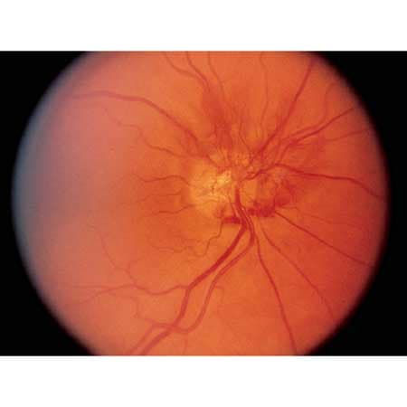 Evaluation of a Large Teleretinal Diabetic Retinopathy Screening Program