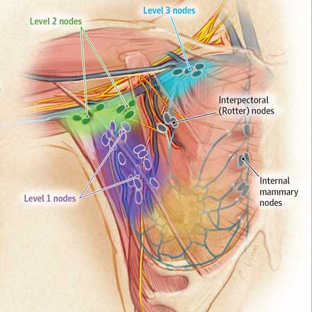 Breast Cancer Surgery: Less Is More