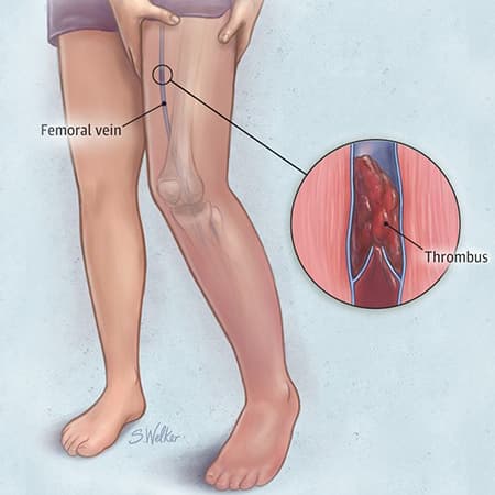 An Update on the Diagnosis and Treatment of Venous Thromboembolic Disease