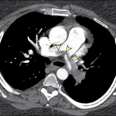 Updated Pulmonary Embolism Guidelines