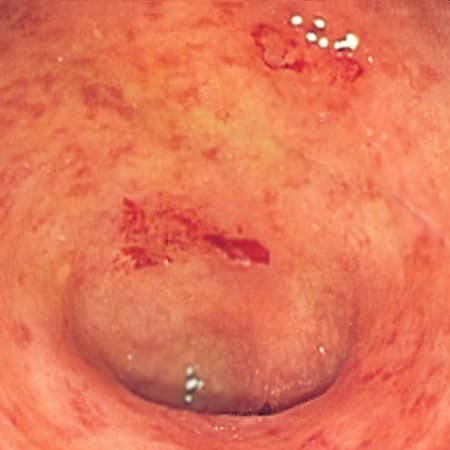 Update on Ulcerative Colitis—2020