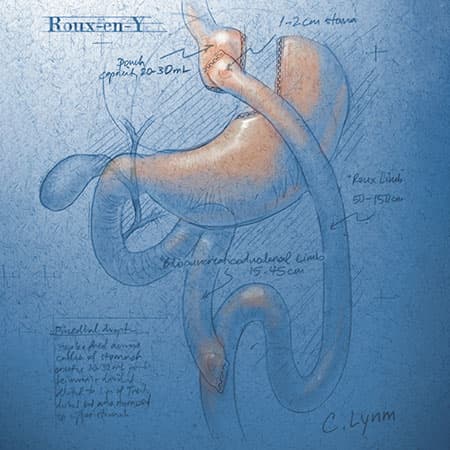 Bariatric Surgery and Cardiovascular Outcomes in Patients With Type 2 Diabetes and Obesity
