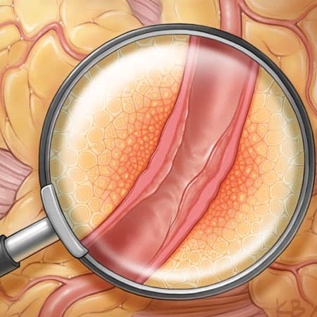 Chronic Stable Angina—Diagnosis and Treatment
