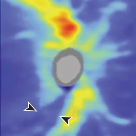 Glaucoma Diagnosis and Treatment