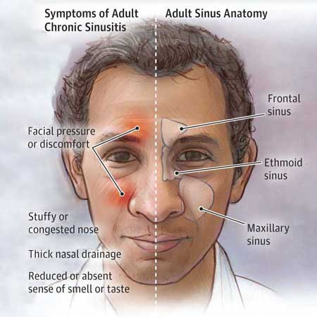 Diagnosis and First-Line Treatment of Chronic Sinusitis