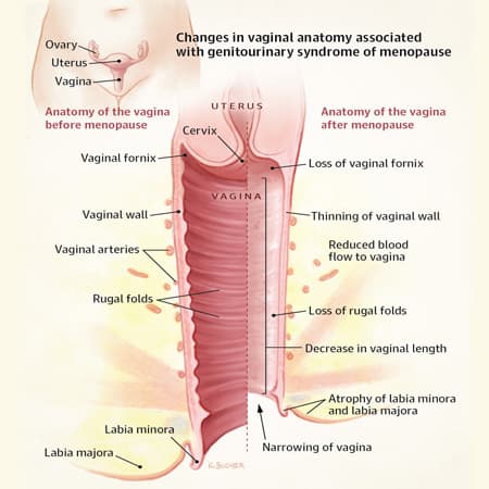 Efficacy of Vaginal Estradiol or Moisturizer vs Placebo for Postmenopausal Vulvovaginal Symptoms