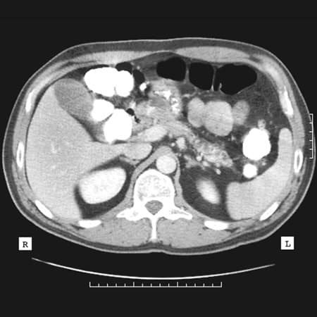 Acute Pancreatitis Part 2 of 2: Treatment