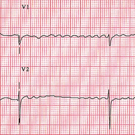 Update on Atrial Fibrillation: Review of the New AHA/ACC/HRS Treatment Guidelines