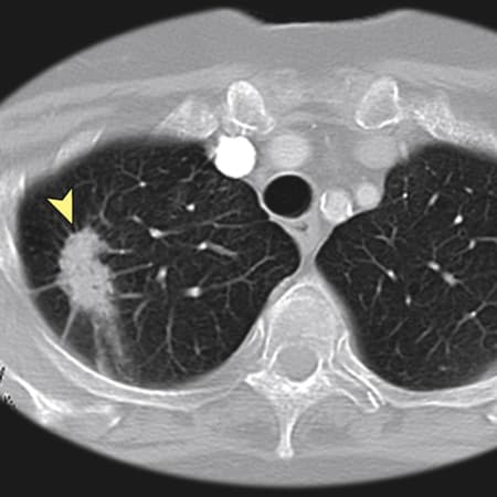 Evaluating Shared Decision Making for Lung Cancer Screening